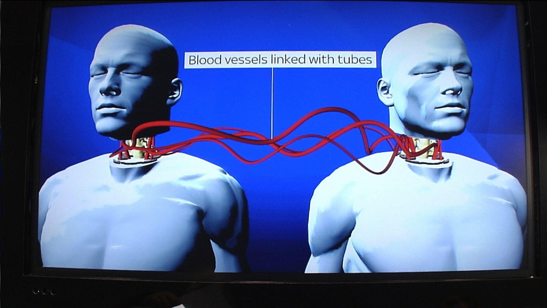 Image result for The World’s First Human Head Transplant Has Been Successfully Carried Out