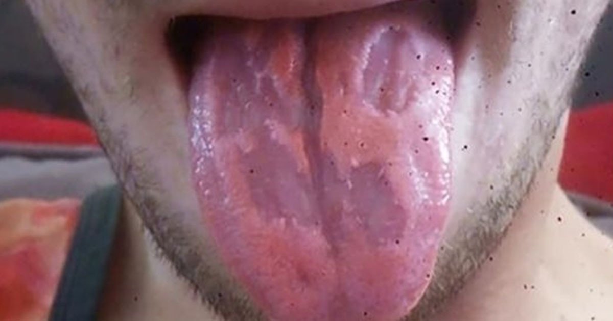 'eaten away' tongue